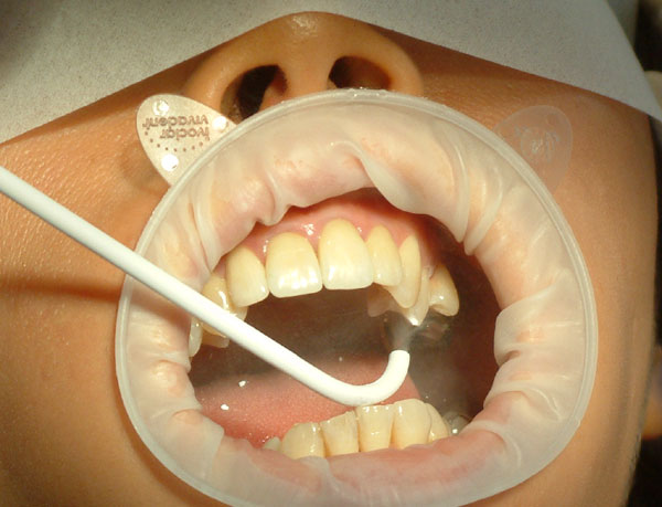 Odbudowa zęba